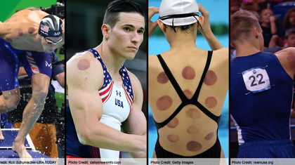 Why Team USA Athletes Are Crazy for Cupping Therapy