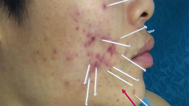 <strong>Acupuncture for Acne</strong>